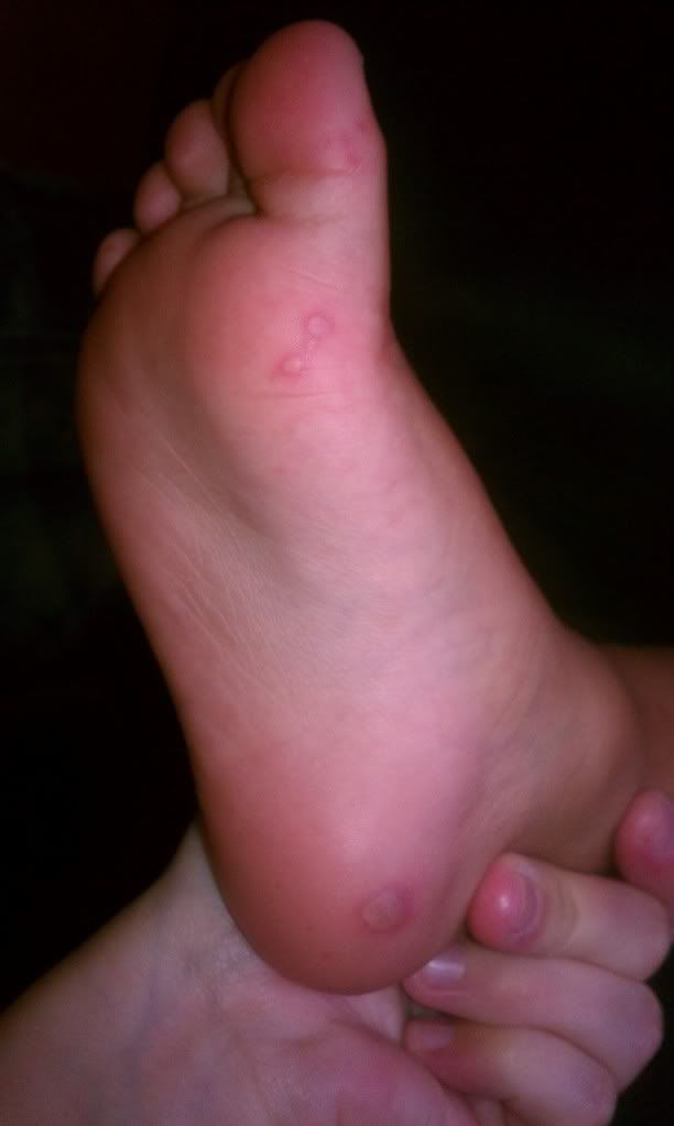 Blisters On Feet White Spots On